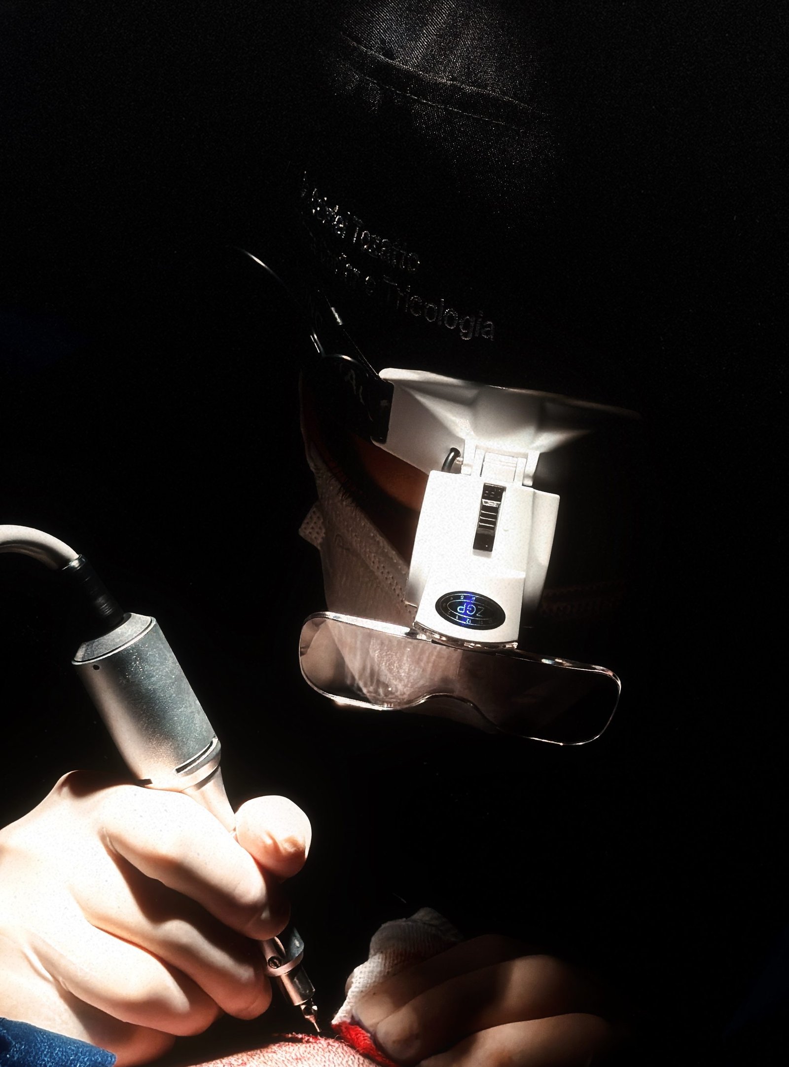 Dr. Gabriel Tozatto implantando fios sob a luz frontal